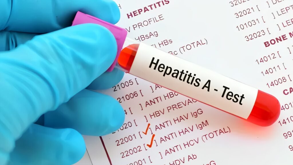 Hepatitis A