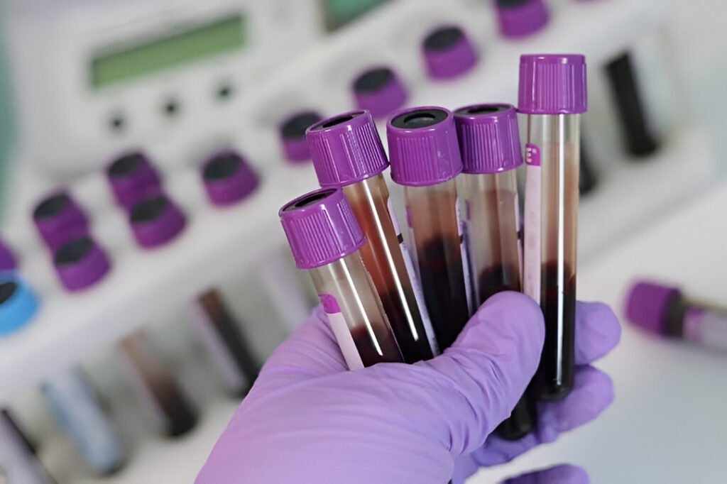 Is Your Blood Type Associated with Stroke Risk? New Research Clarifies